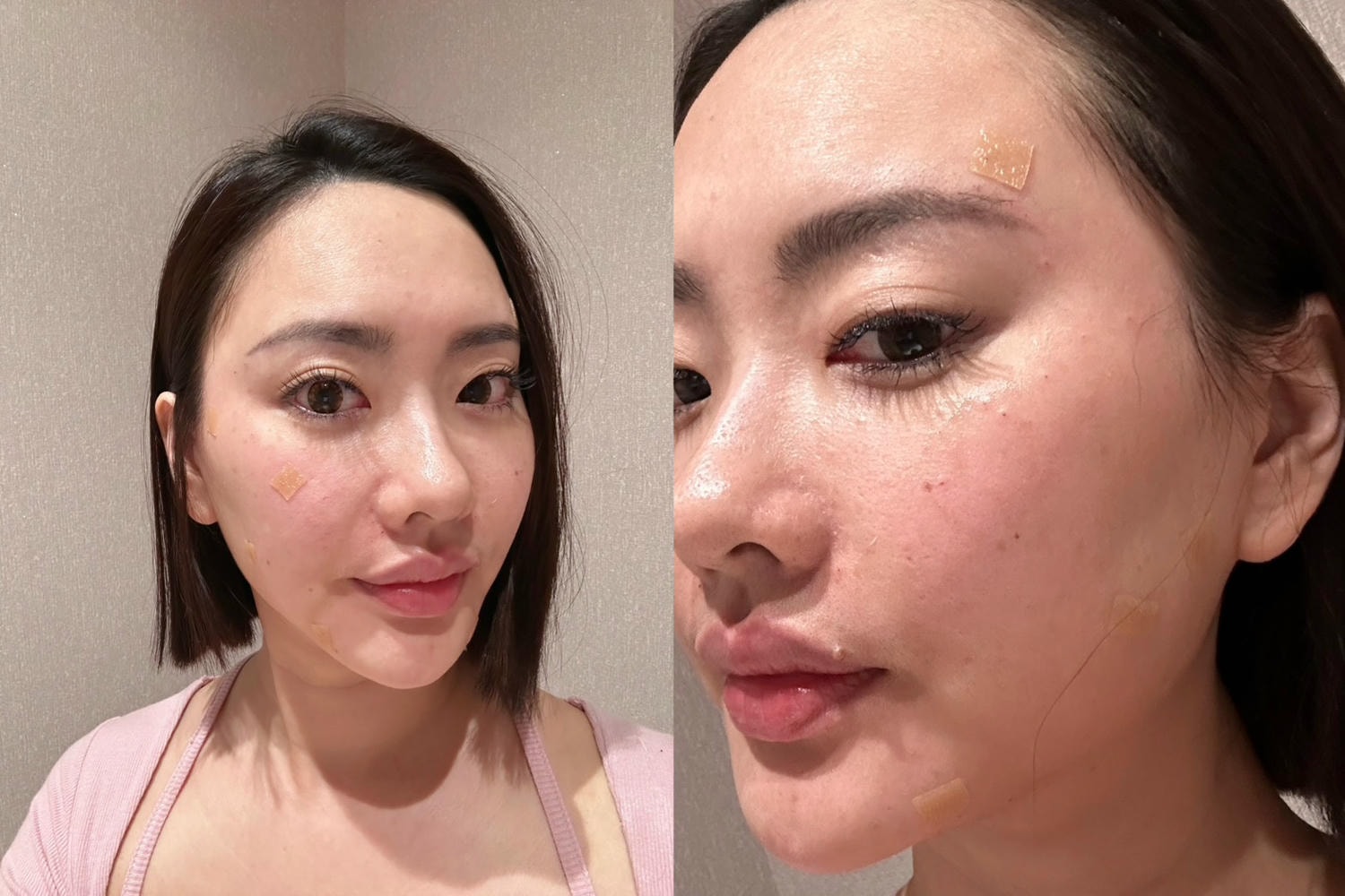 第一次接觸膠原蛋白增生劑｜薇貝拉在上立美學皮膚科的諮詢與體驗心得