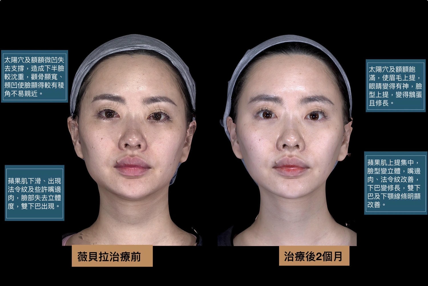 第一次接觸膠原蛋白增生劑｜薇貝拉在上立美學皮膚科的諮詢與體驗心得