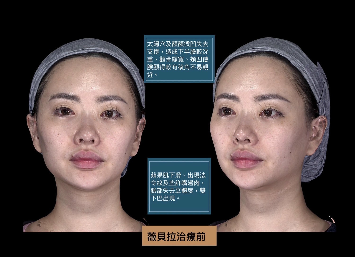 第一次接觸膠原蛋白增生劑｜薇貝拉在上立美學皮膚科的諮詢與體驗心得